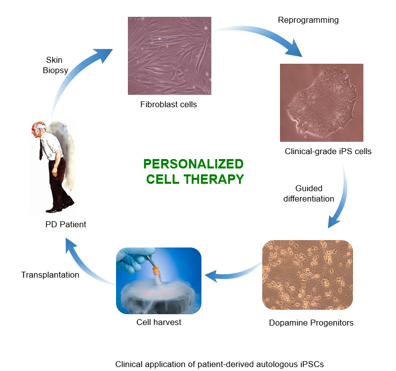 그림 1. 맞춤형 줄기세포를 이용한 파킨슨병 치료법 모식도