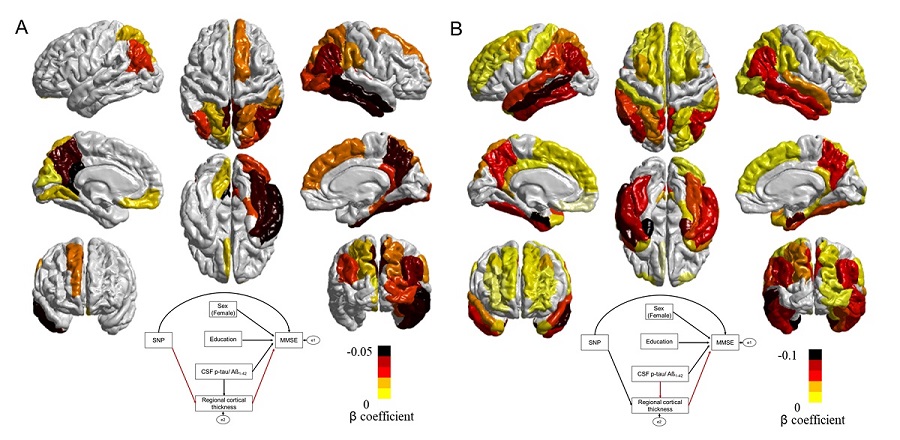 그림 2. 유전인자가 대뇌피질 위축을 일으킴을 보여주는 그림