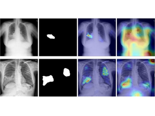 스스로 진화하는 흉부 엑스선 인공지능 진단기술 개발 이미지