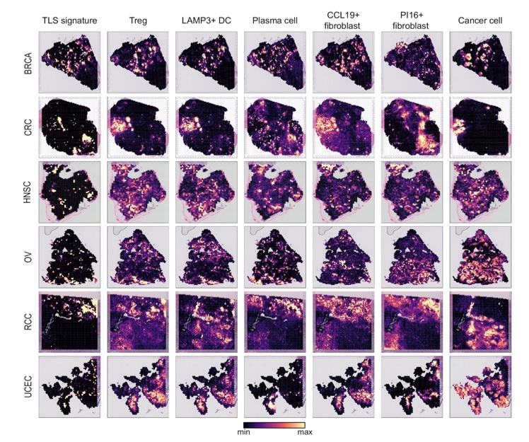 그림 4. 다양한 암종에서 관찰한 삼차 림프 구조와 그 구성 세포들의 공간적 배열 양상