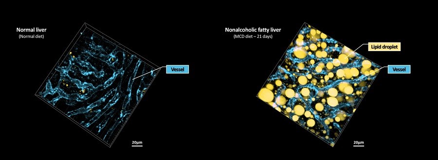 Image 1: Researchers developed a way to visualize the progression of nonalcoholic fatty liver disease (NAFLD) in mouse models of the disease. Using the technique, they captured lipid droplet accumulation (yellow) and microvasculature (blue) in the livers of normal mice and mice with NAFLD induced with a methionine and choline deficient (MCD) diet.